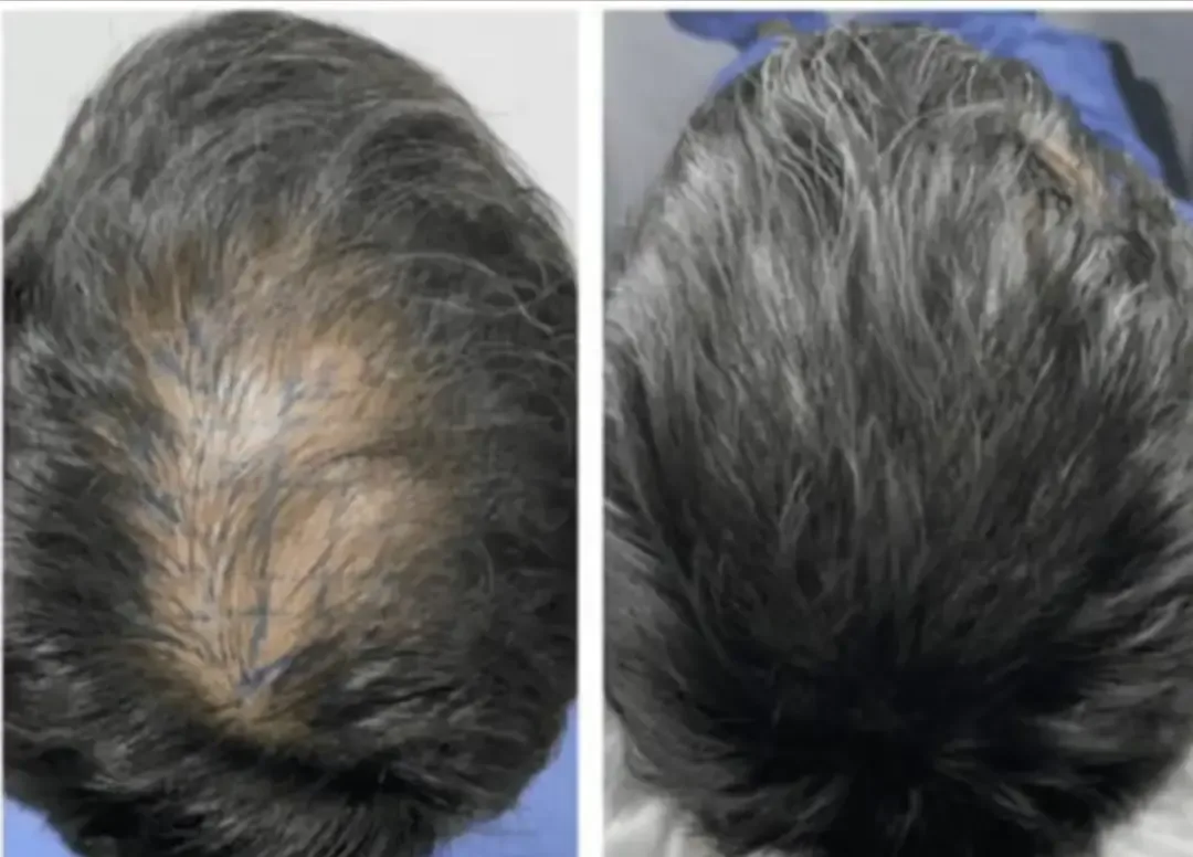 Antes y después de un injerto capilar en Shim Clinic