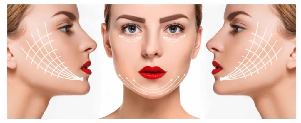 Esquema de las zonas del rostro que pueden tratarse: pómulos, ojeras, mentón y línea mandibular