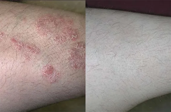 Antes y después del tratamiento de la psoriasis con láser