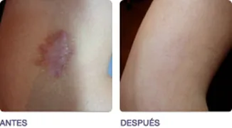 Antes y después del tratamiento de una cicatriz